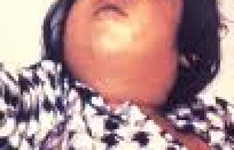 דיפתריה מחלת גרון (קרמת לועזית diphtheria) בלשון התלמוד: אסכרה, סרונכי.