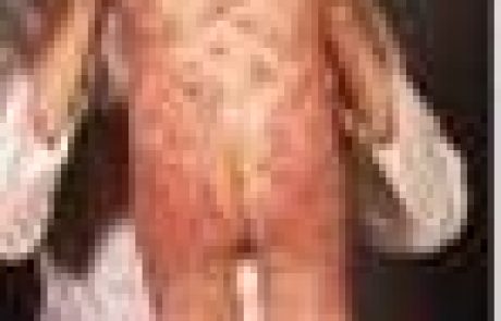 מחלת עור בלשון התלמוד חזזיתא/חזזית מצרית