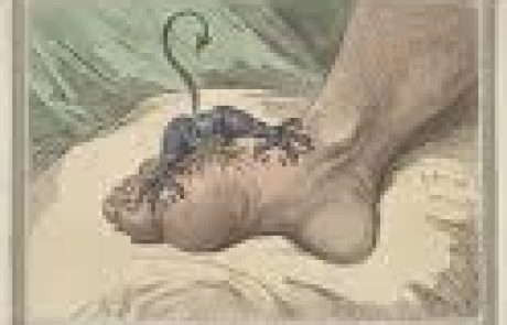 מחלת השגדון (gout) בלשון התלמוד: פודגרא, צינית, בת ארעא.