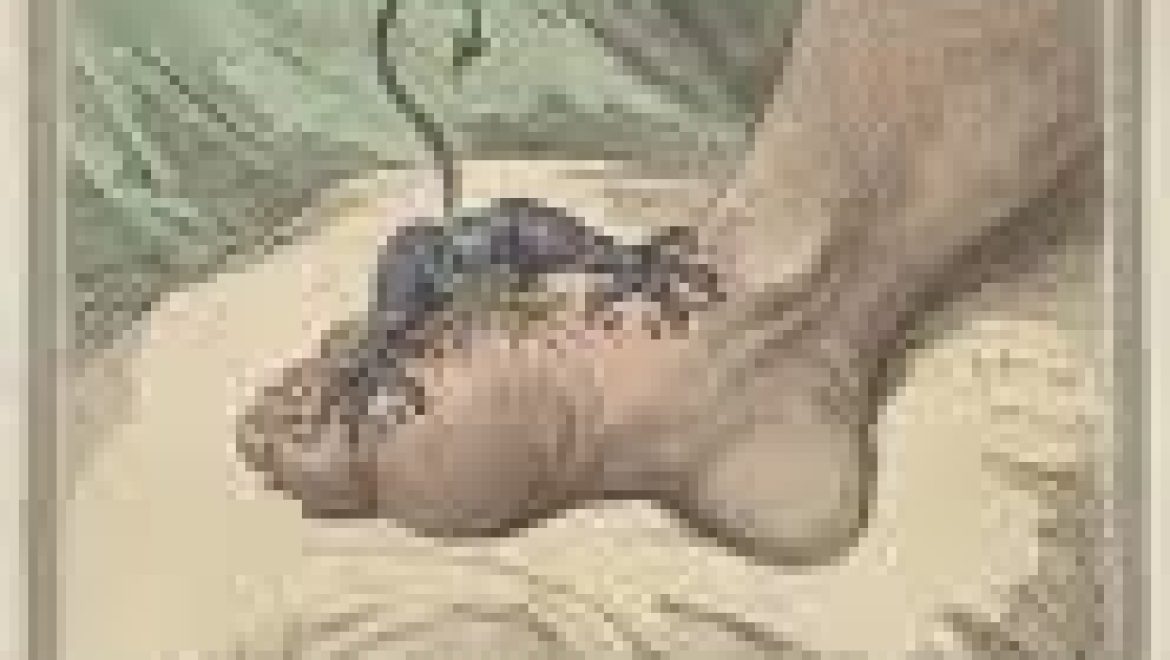 מחלת השגדון (gout) בלשון התלמוד: פודגרא, צינית, בת ארעא.