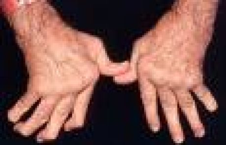 דלקת מפרקים – שגרון (ARTHRITIS) בלשון התלמוד שיגרונא