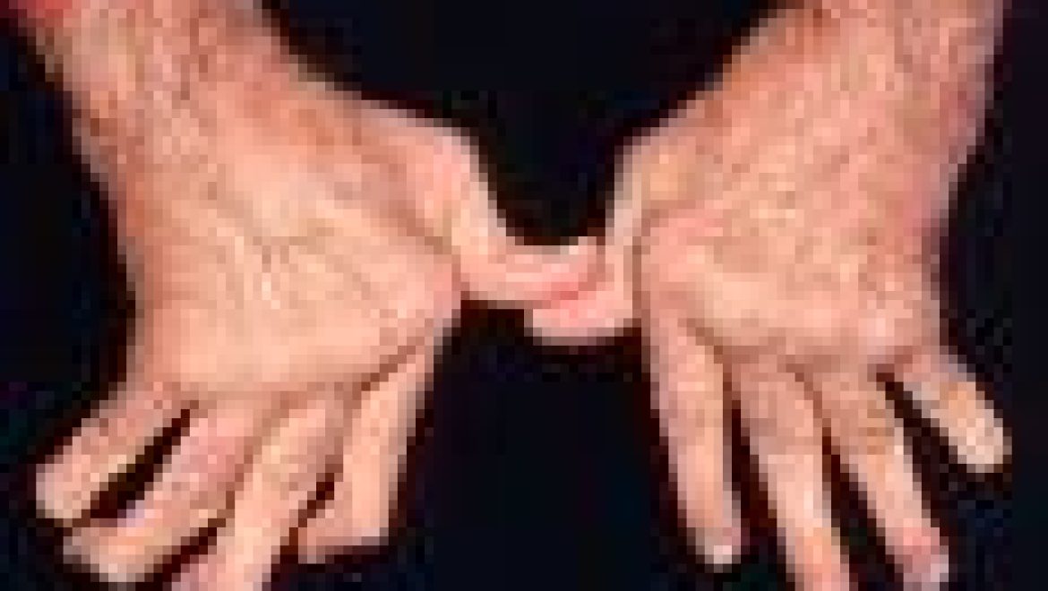 דלקת מפרקים – שגרון (ARTHRITIS) בלשון התלמוד שיגרונא